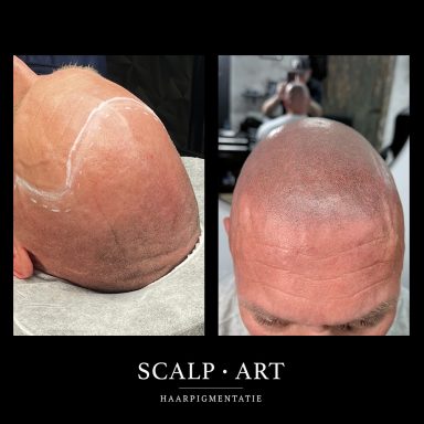 Natuurlijke shaved look met MHP Voor- en nafoto van haarpigmentatie (MHP/SMP) met een natuurlijke shaved look en realistisch eindresultaat.