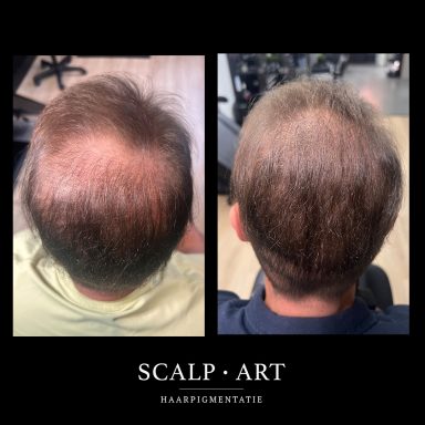 haarpigmentatie opvullen kruin haarpigmentatie opvulling kruin scalp art