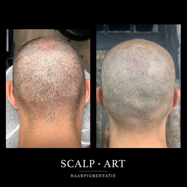 Littekenweefsel opgevuld met haarpigmentatie MHP scalpart bergen op zoom en omgeving zeeland goes