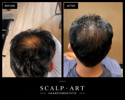 Kruin opgevuld met haarpigmentatie Voor- en naresultaat van microhaarpigmentatie (MHP/SMP) waarbij een dunne kruin optisch voller is gemaakt met een natuurlijk ogend resultaat