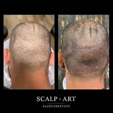 Haarpigmentatie Kruin | Natuurlijk Resultaat | Scalp Art bergen op zoom
