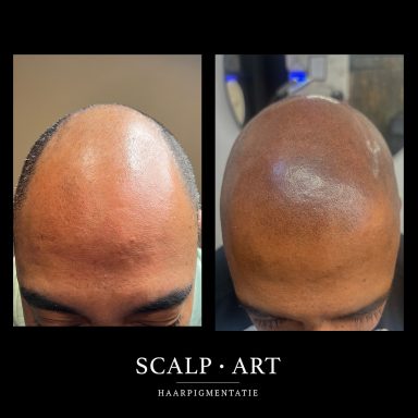 Shaved look met haarpigmentatie voor een natuurlijke haarlijn bergen op zoom en omgeving