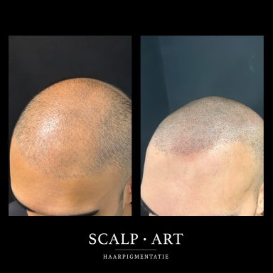 Haarpigmentatie voor meer dichtheid | Scalp Art Bergen op Zoom en omgeving goes en kapelle